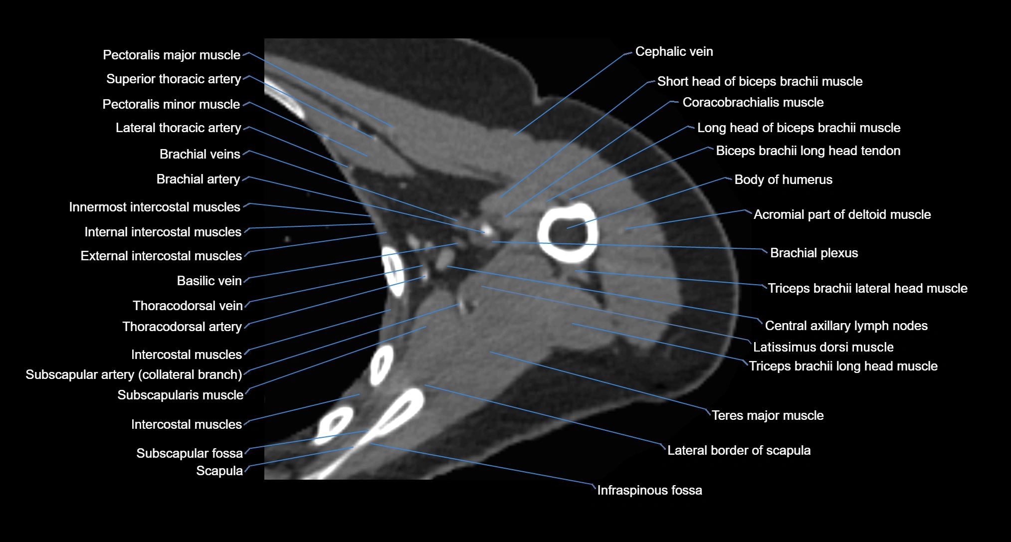 CT Shoulder axial cross sectional anatomy labelled radiology image -00056.webp